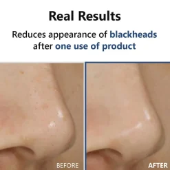 Clearance Hyper Acid4 AHA BHA PHA LHA 30 Serum Korean Skincare|Serum