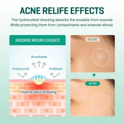 Sale SOME BY MI Clear Spot Patch*2ea Pimple Patches